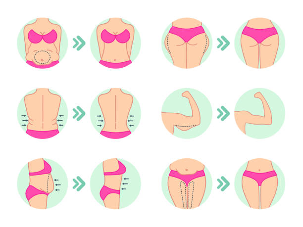 lipo.image