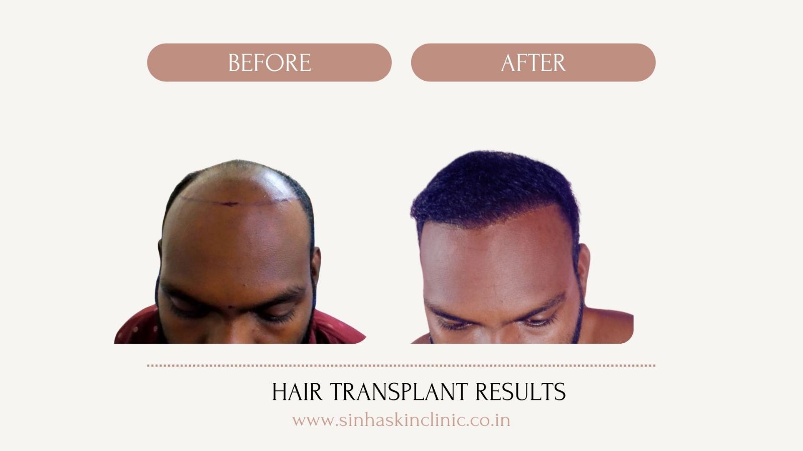 Hair Density Bilaspur