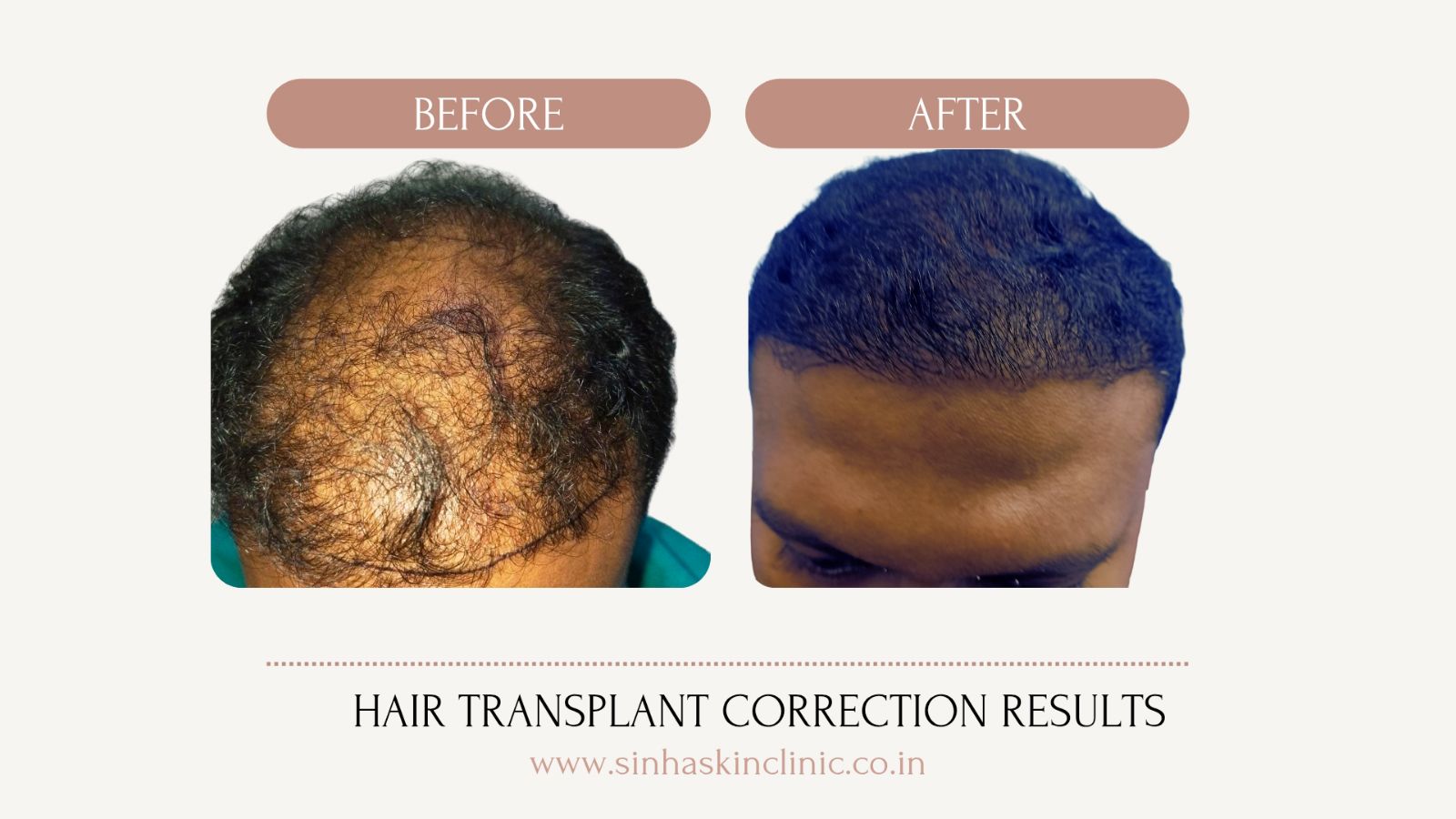 Hair Transplant Result Bilaspur