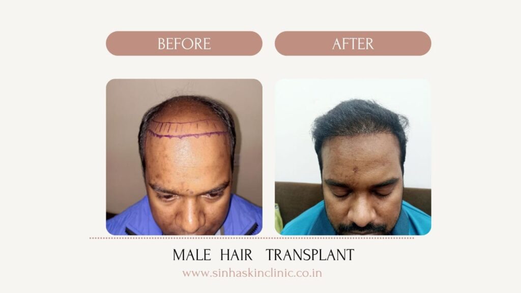 Male hair transplant raipur