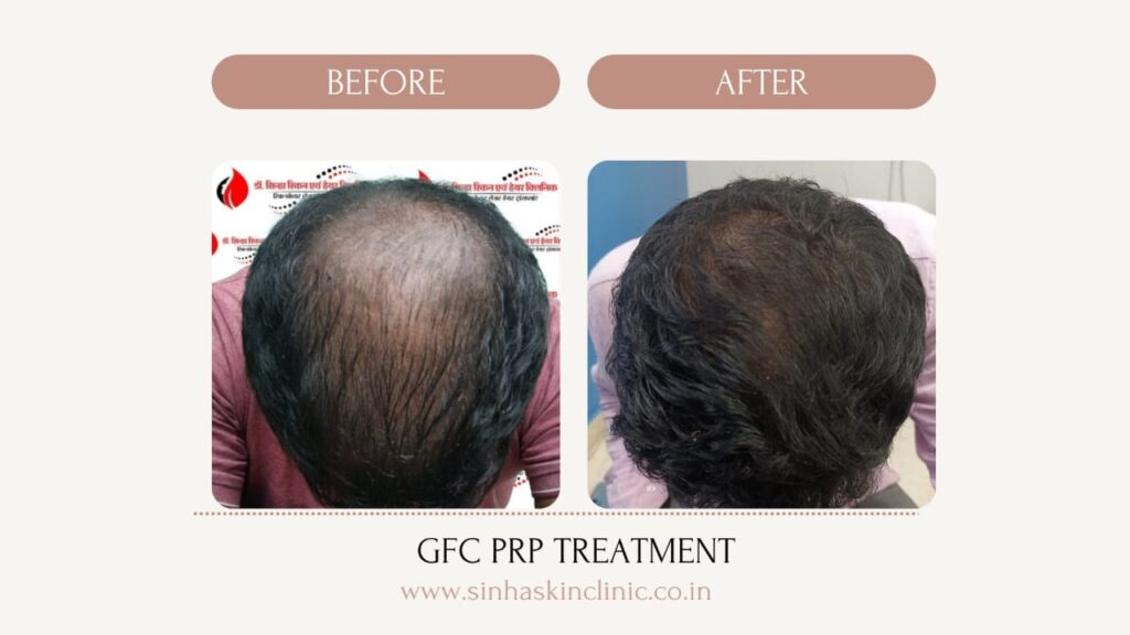 GFC PRP treatment
