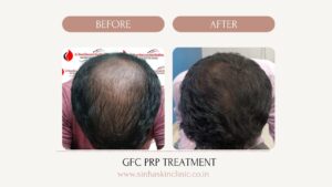 platelet based treatment