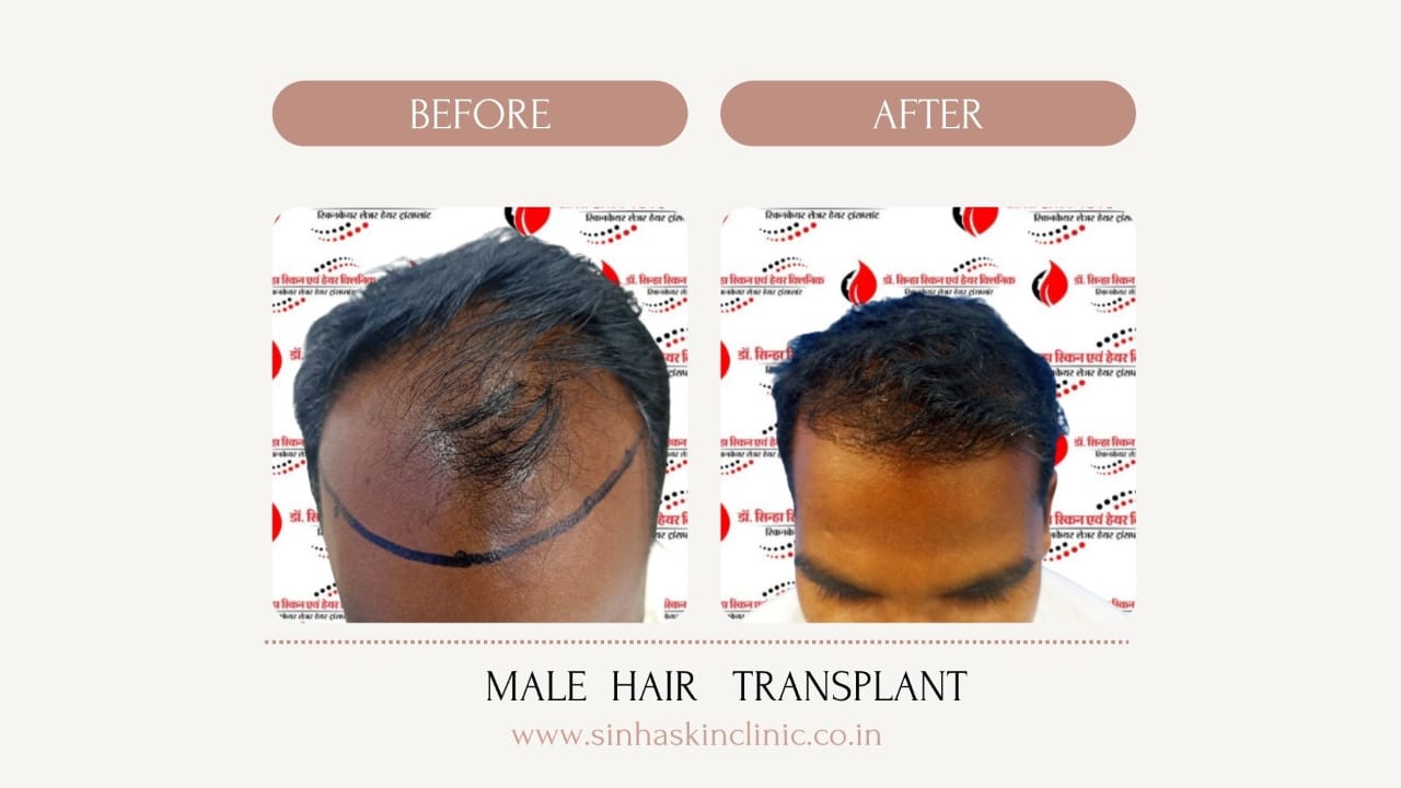 Crown Hair Transplant Raipur