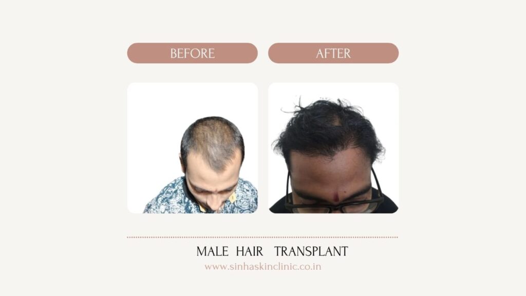 hair transplant