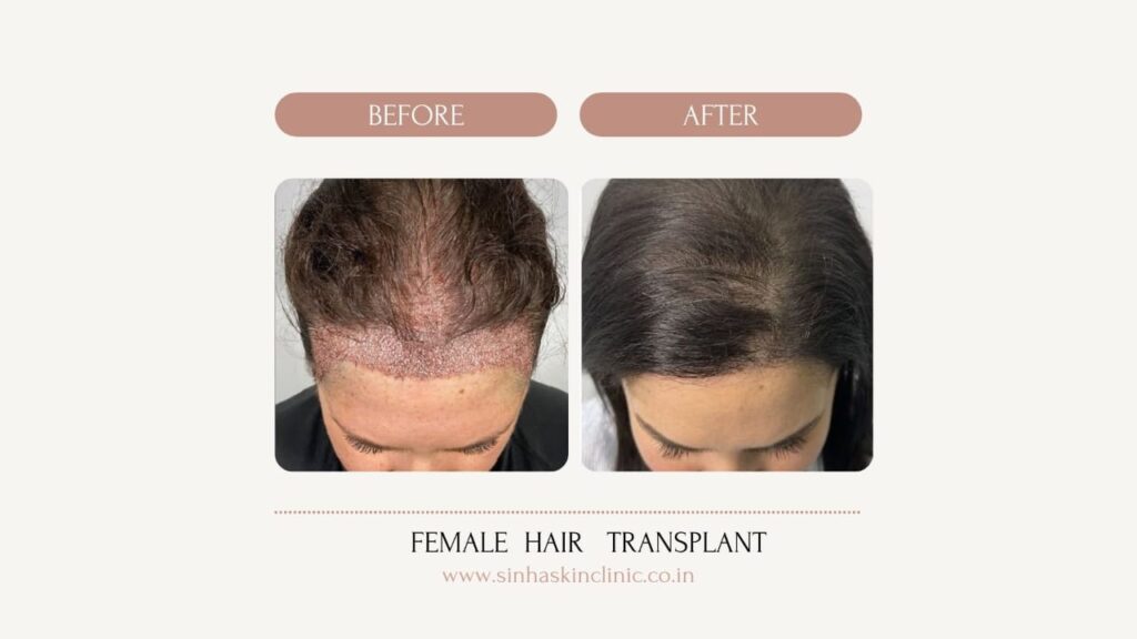 female hair transplant jagdalpur