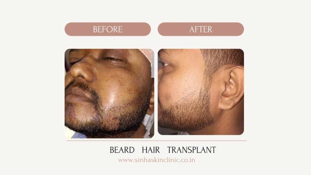 beard hair transplant jagdalpur