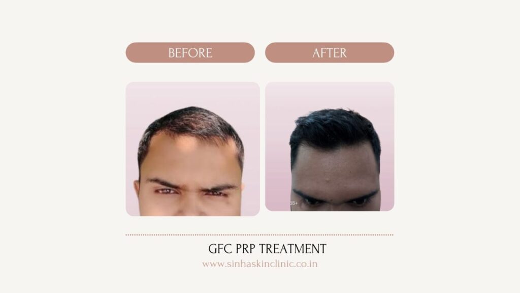 GFC PRP treatment