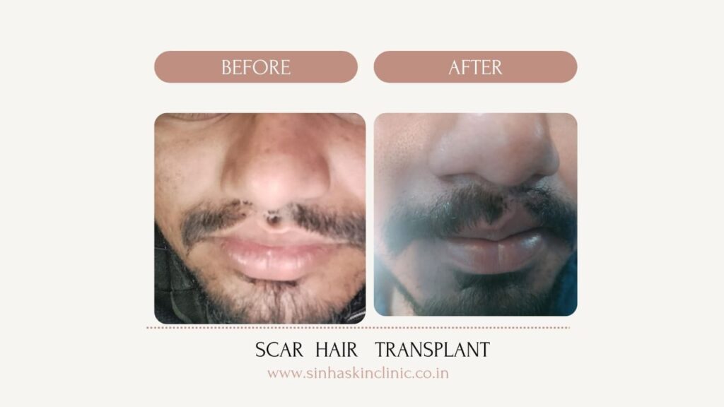 scar hair transplant raipur