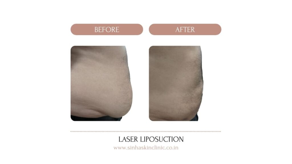 lipo