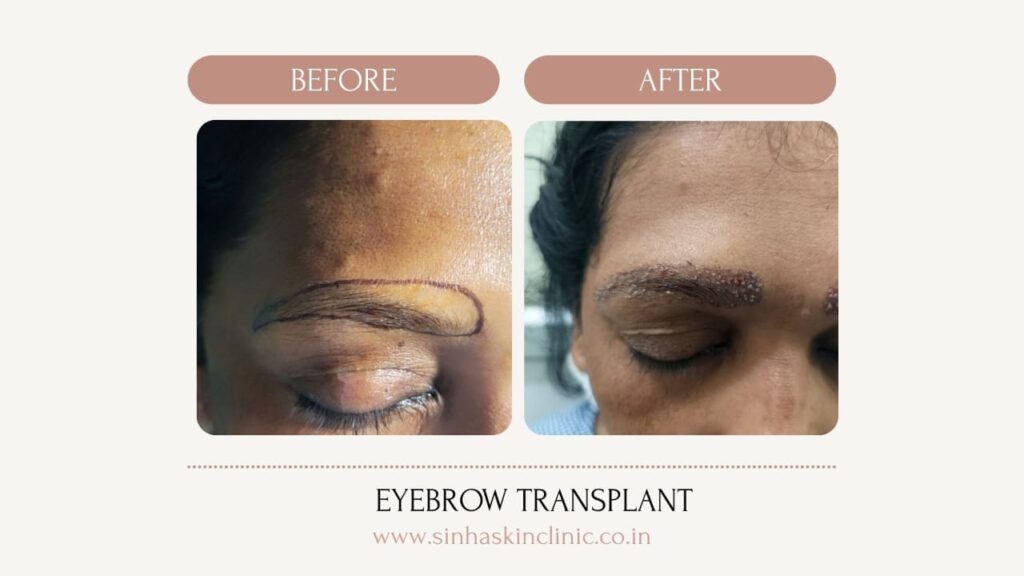eyebrow transplant jagdalpur
