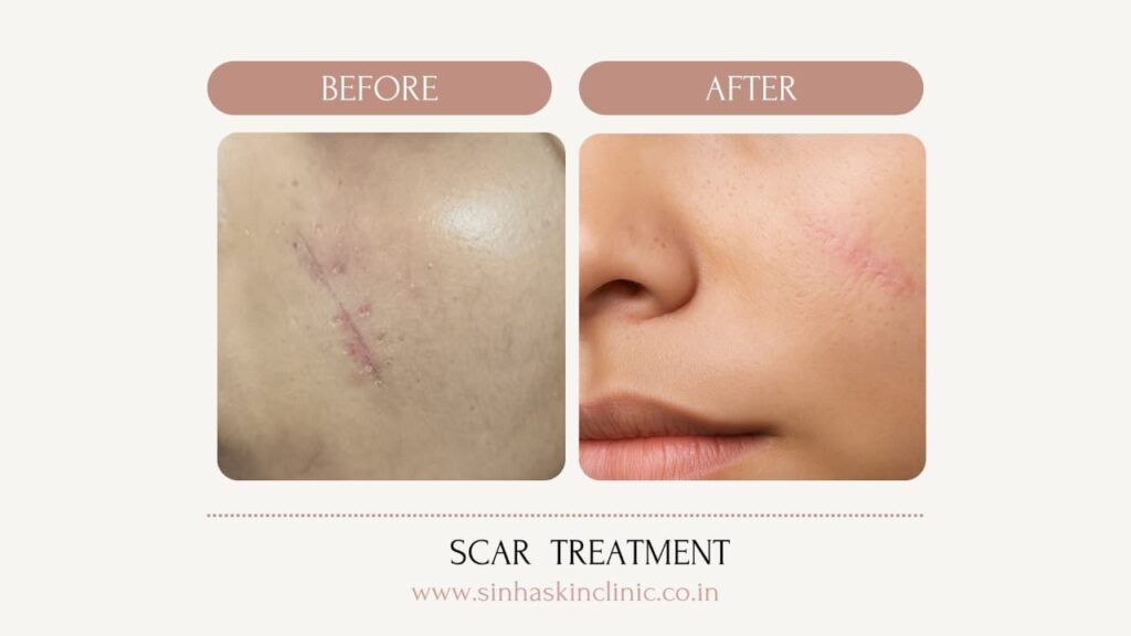 scar revision