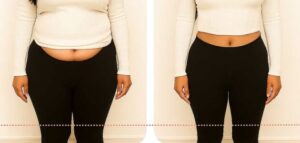 liposuction fat loss